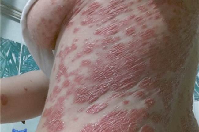 Псориаз после родов