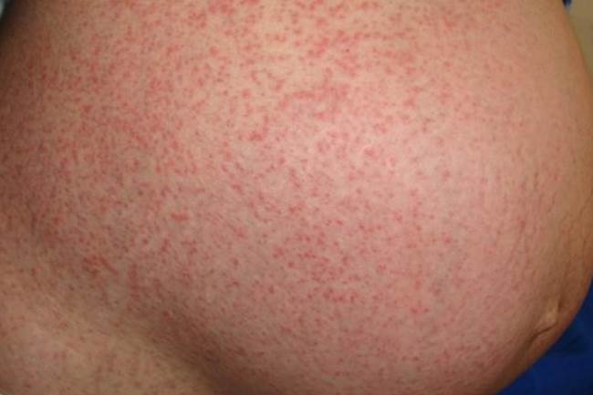 Псориаз при беременности