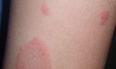 Детский псориаз