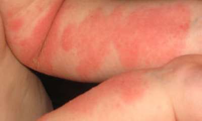 Псориаз у грудничков