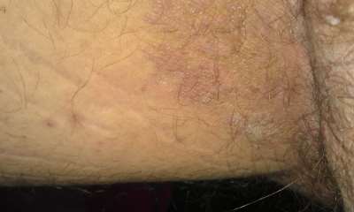 Паховый псориаз у мужчин фото