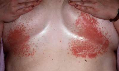 Псориаз на груди