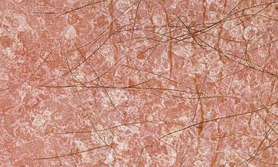 Сухая кожа при псориазе