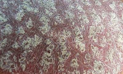 Шелушение кожи при псориазе