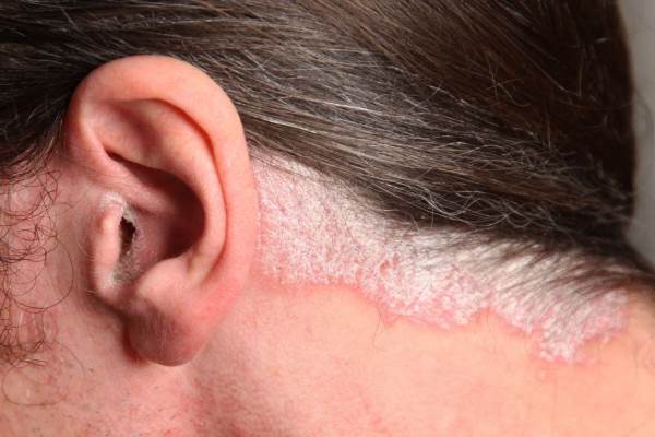 Псориаз за ухом