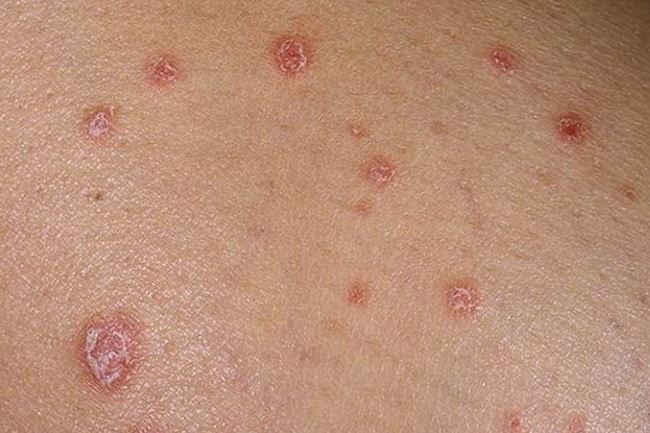 Как начинается псориаз