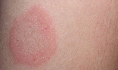 Начальная стадия псориаза