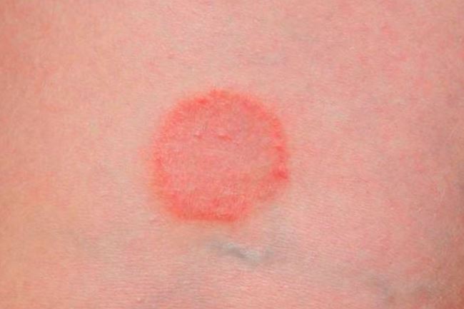 Первая стадия псориаза