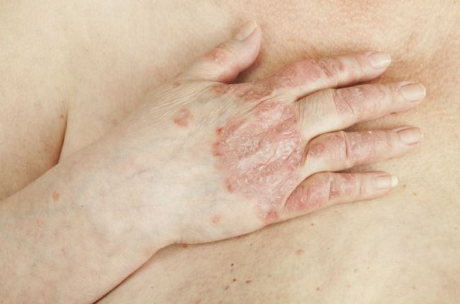 Симптомы и лечение псориаза