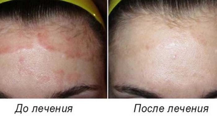 Отзывы на лосьон Фуфан