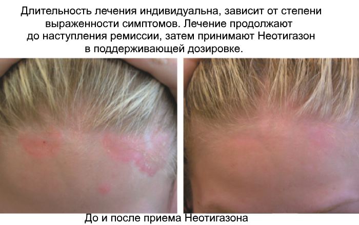 Отзывы на Неотигазон при псориазе