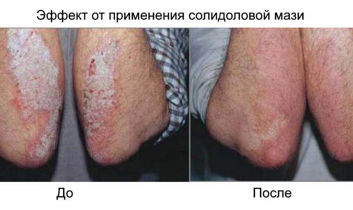 Отзывы на солидол от псориаза