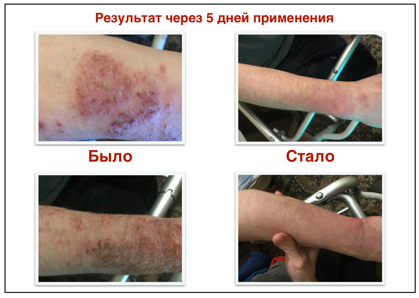 Здраводерм Восстановитель кожи от псориаза