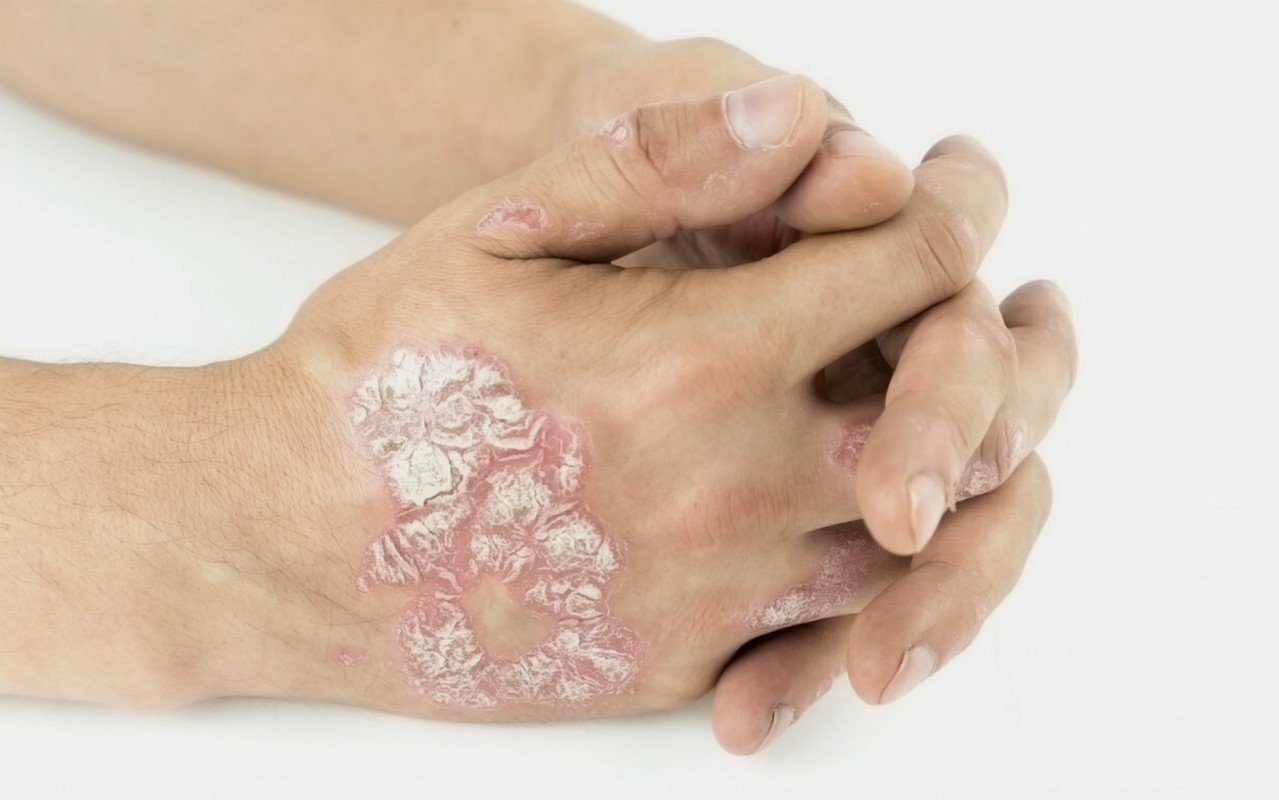 С псориазом мобилизуют или нет