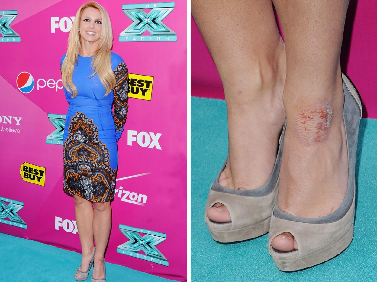 псориаз у знаменитостей