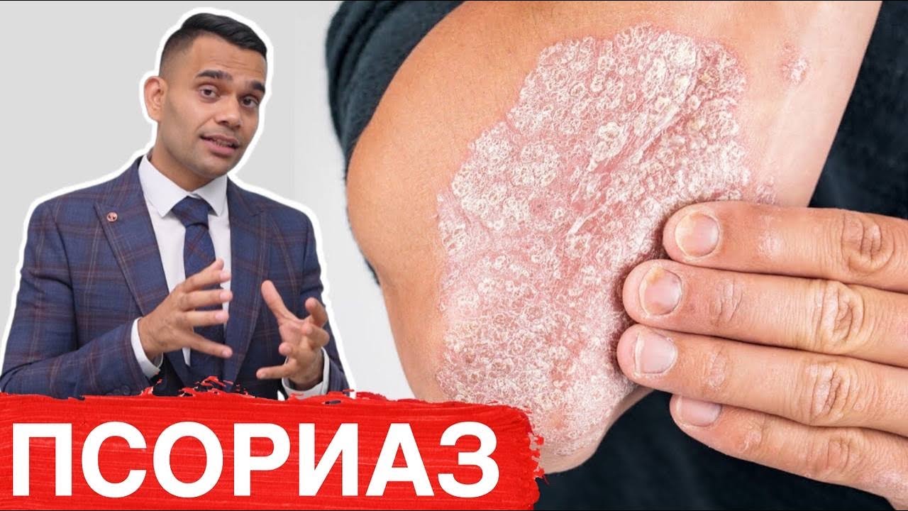 Запущенный псориаз что делать