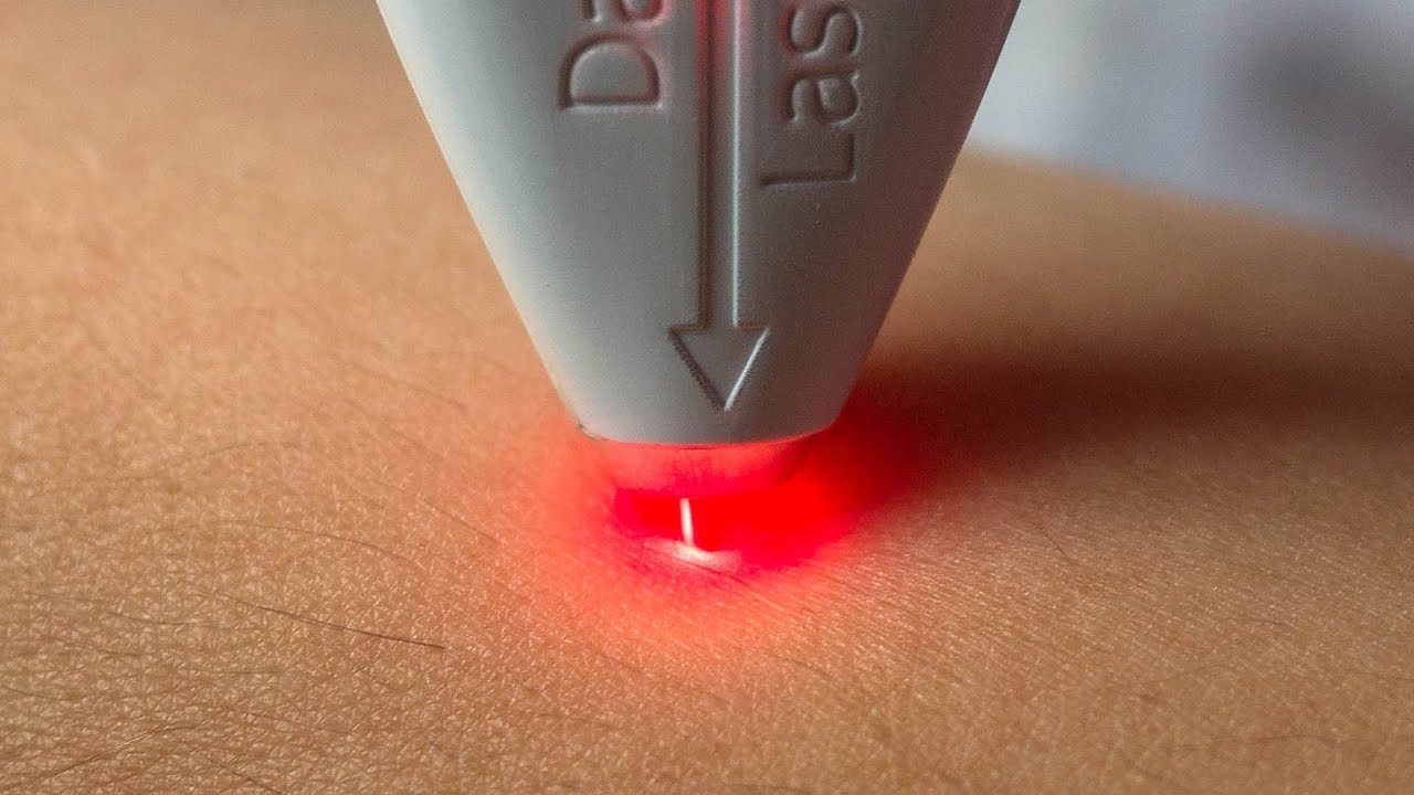 Лечение псориаза лазером