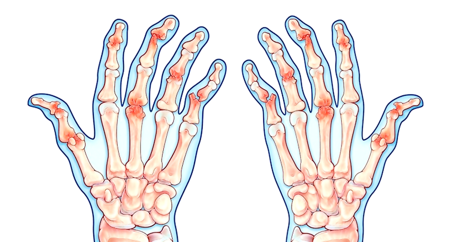 Симптомы псориаза суставов