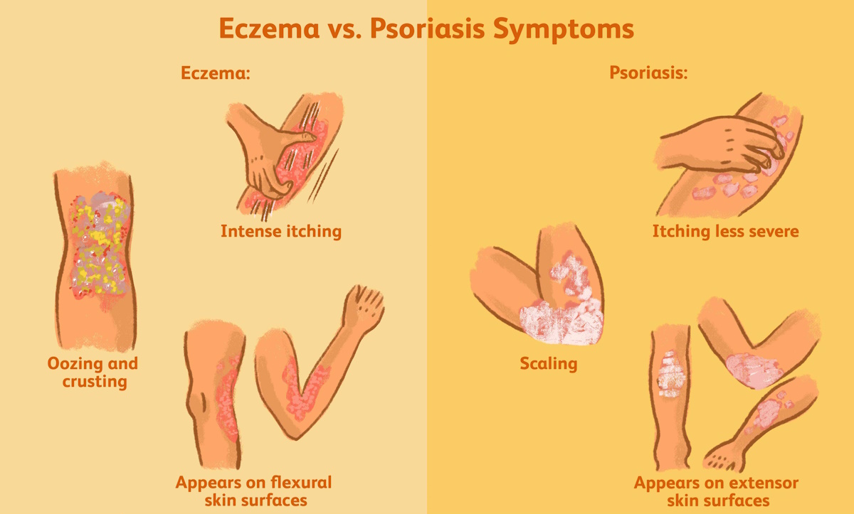 Чем отличается экзема от псориаза