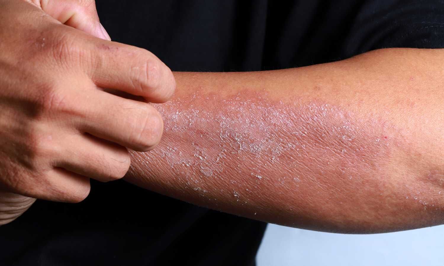 Чем снять зуд при псориазе