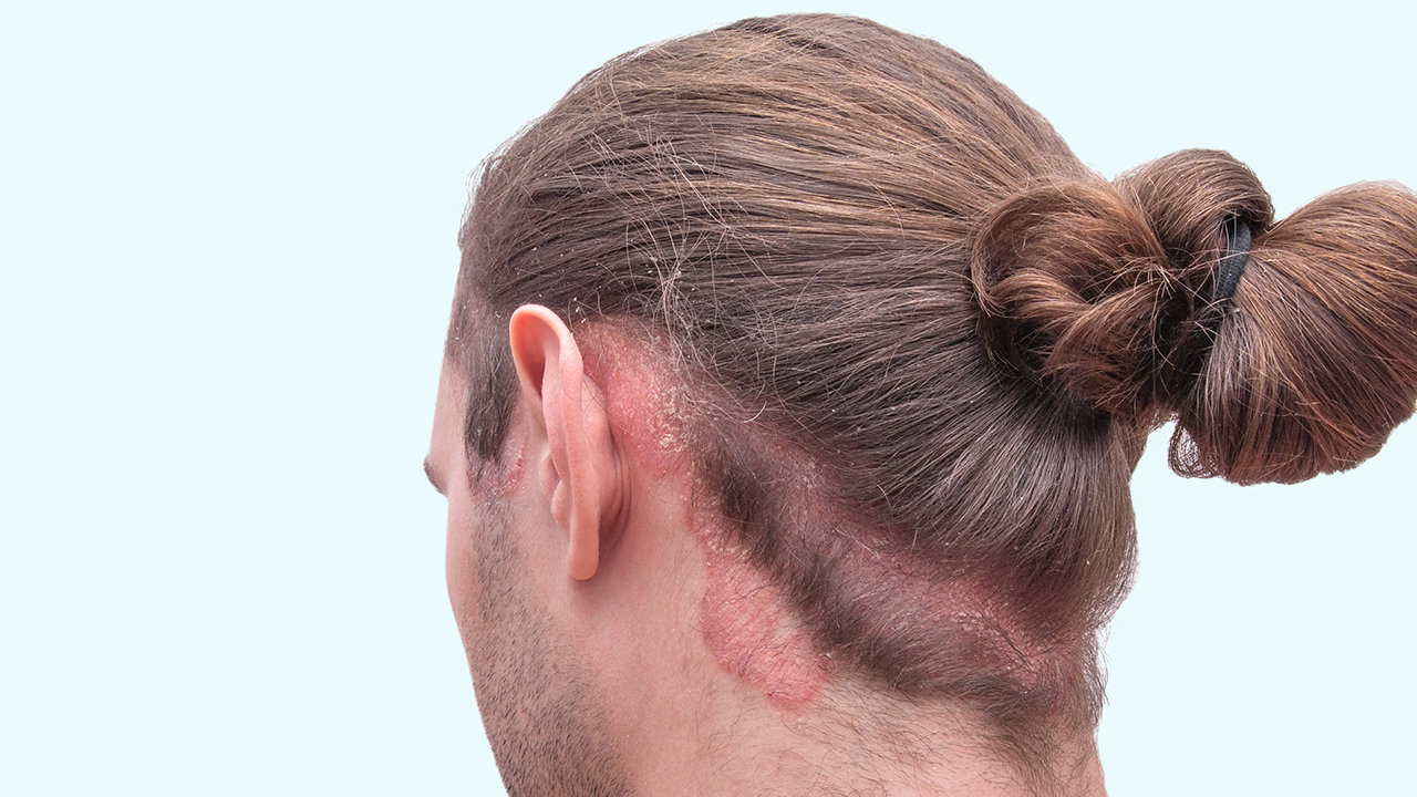 Диета при псориазе волосистой части головы