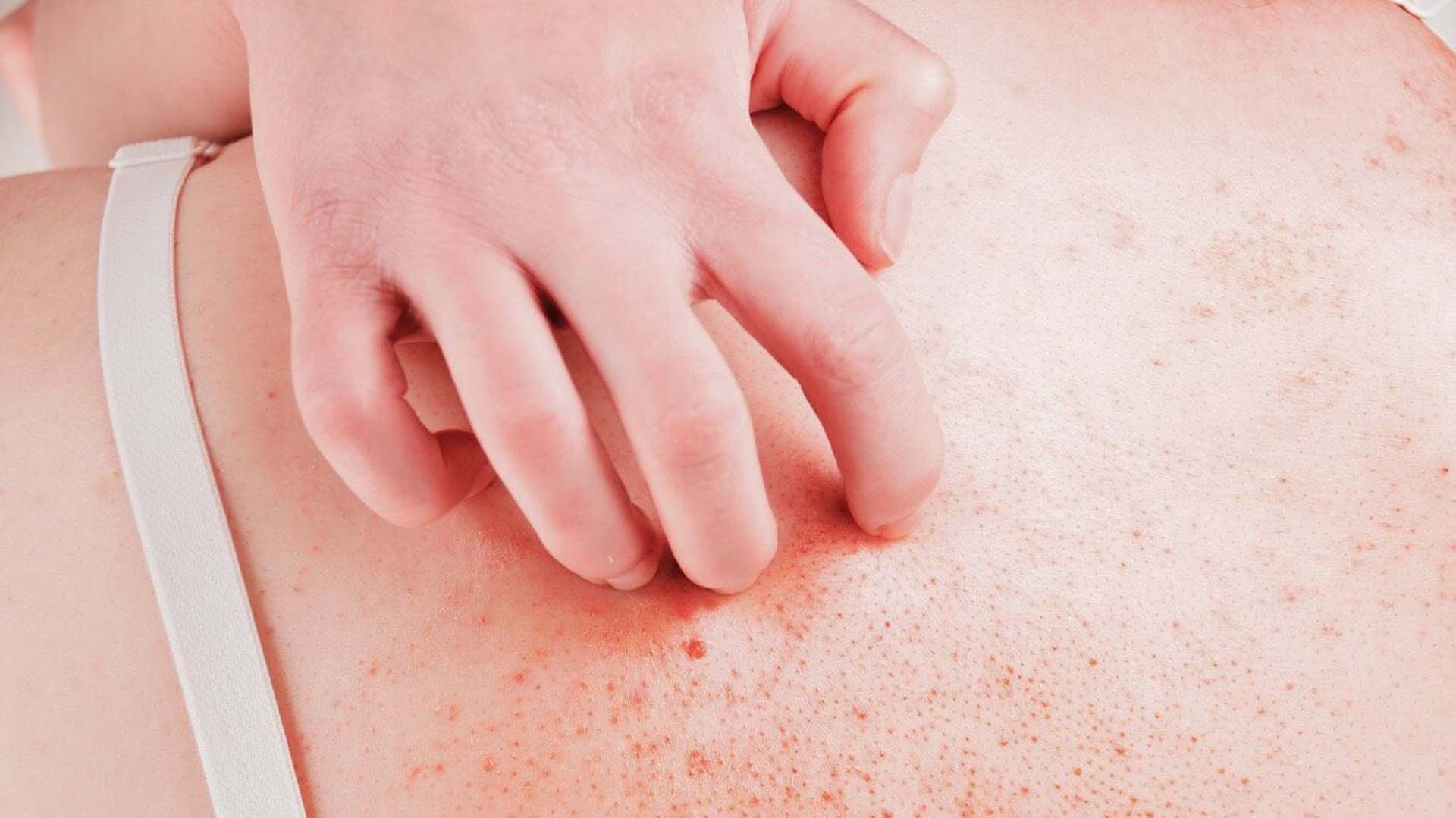 Псориаз от нервов