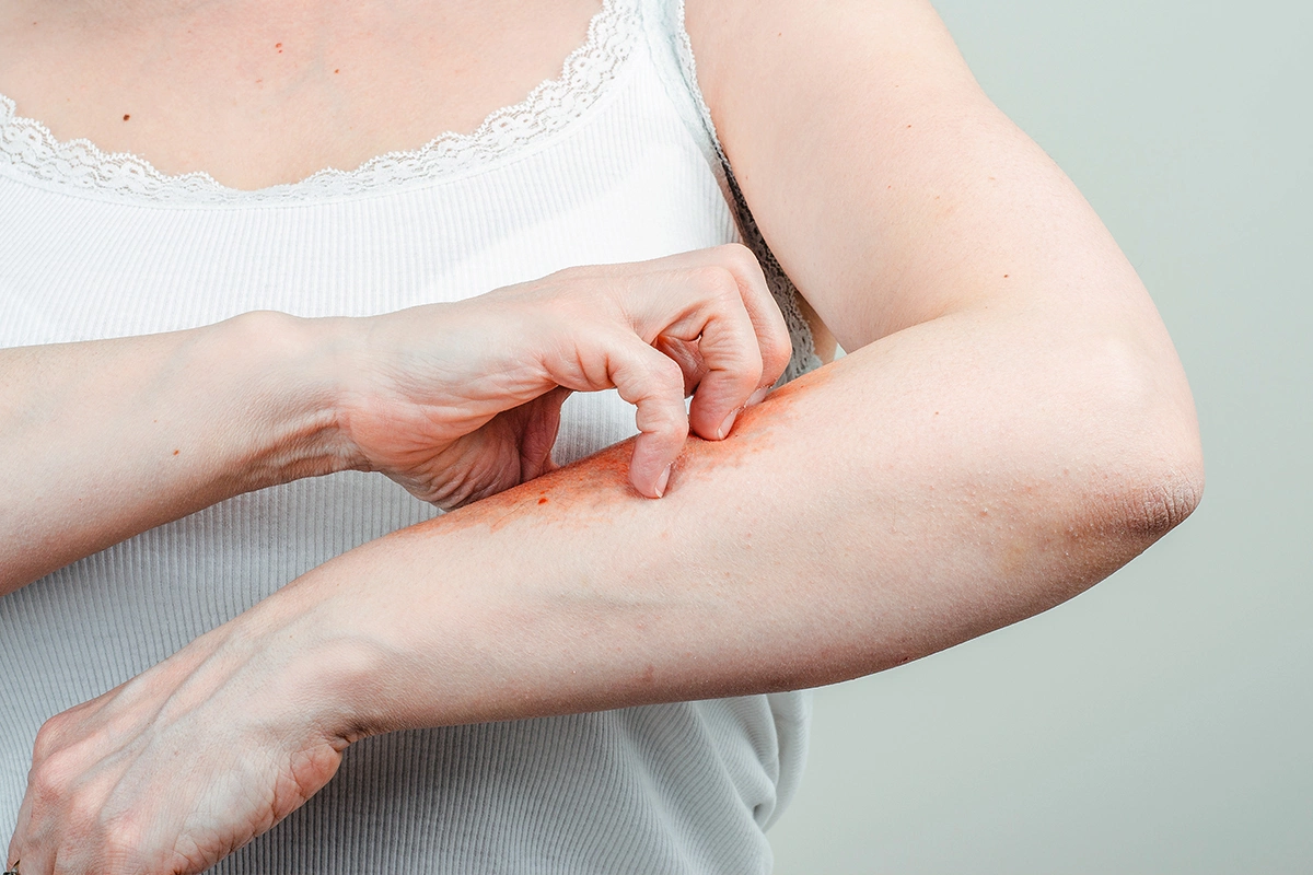 Таблетки от зуда при псориазе