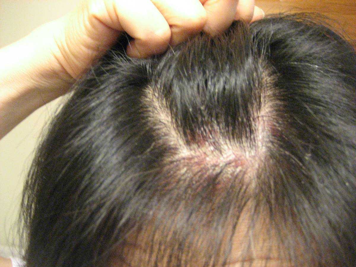 Чешется затылок причины. Себорейный дерматит волосистой части. Себорейный дерматит на волосах. Асбестовидный себорейный дерматит.