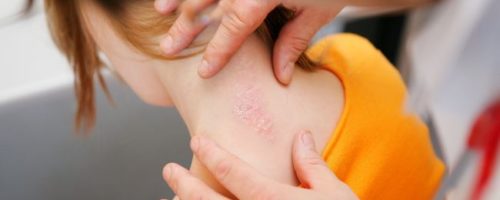 Псориаз у детей