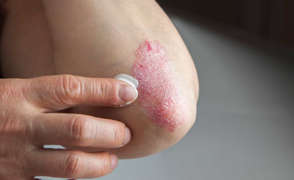 Мазь от псориаза