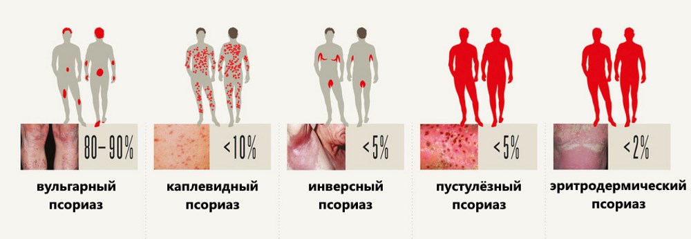 Причины псориаза