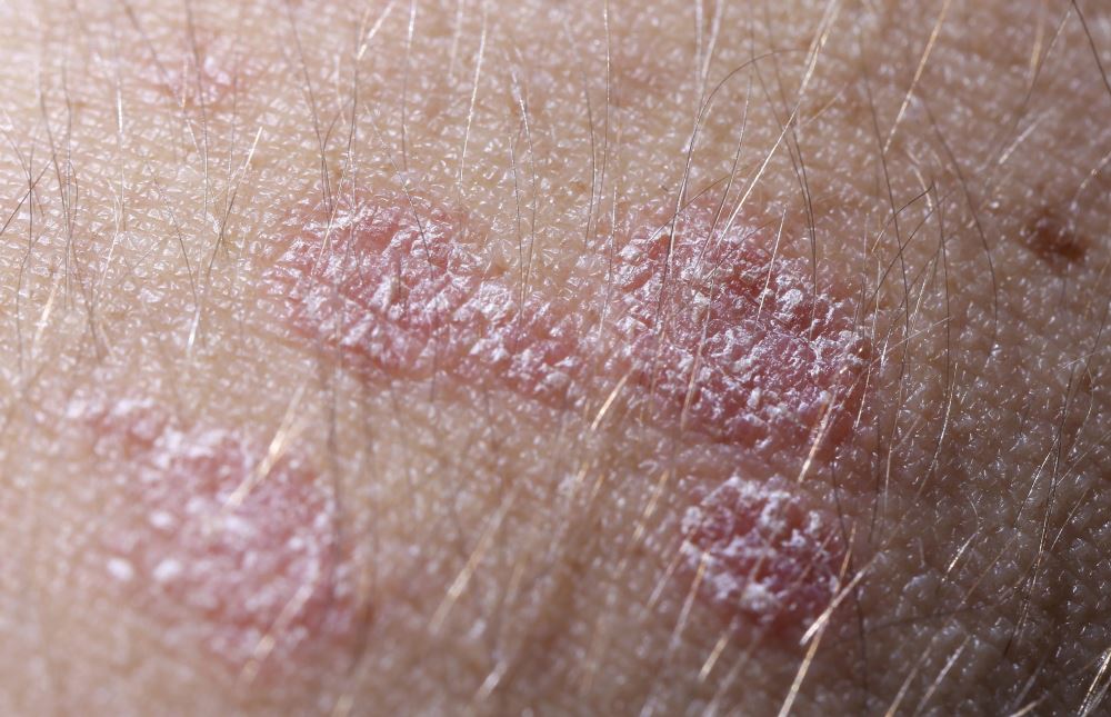 Псориаз в начальной стадии