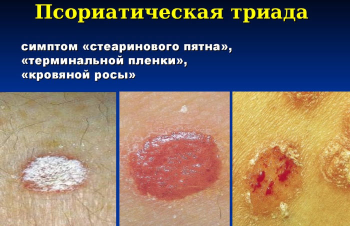 Как проявляется псориаз