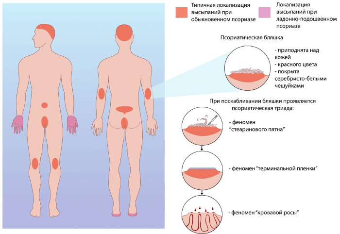 Проявление псориаза