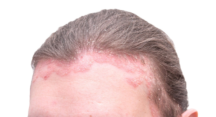Псориаз волосистой части головы