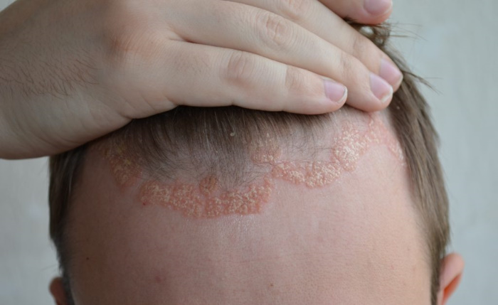Псориаз у детей